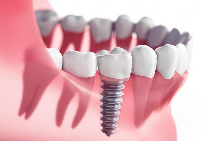 Dental Implants - Parkwood Dental Associates